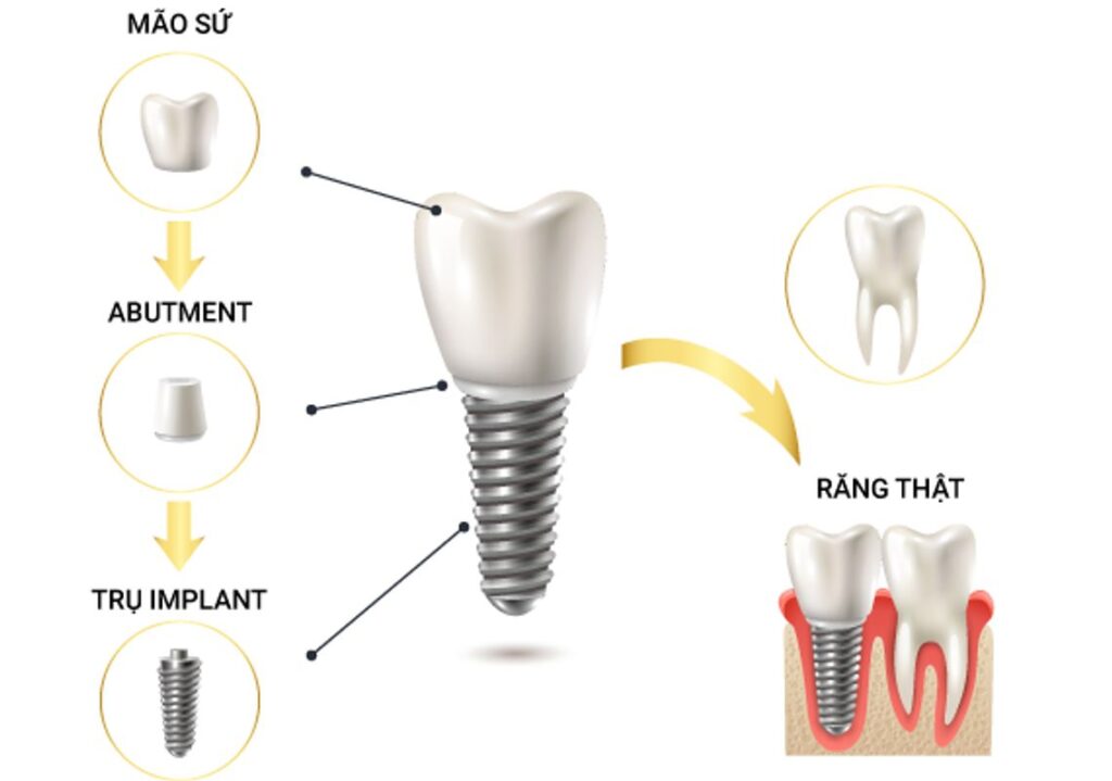 Implant