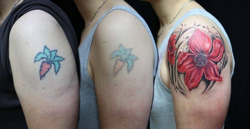 How Much Is Tattoo Removal