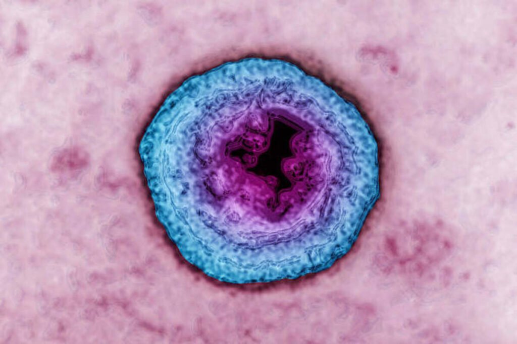genital herpes