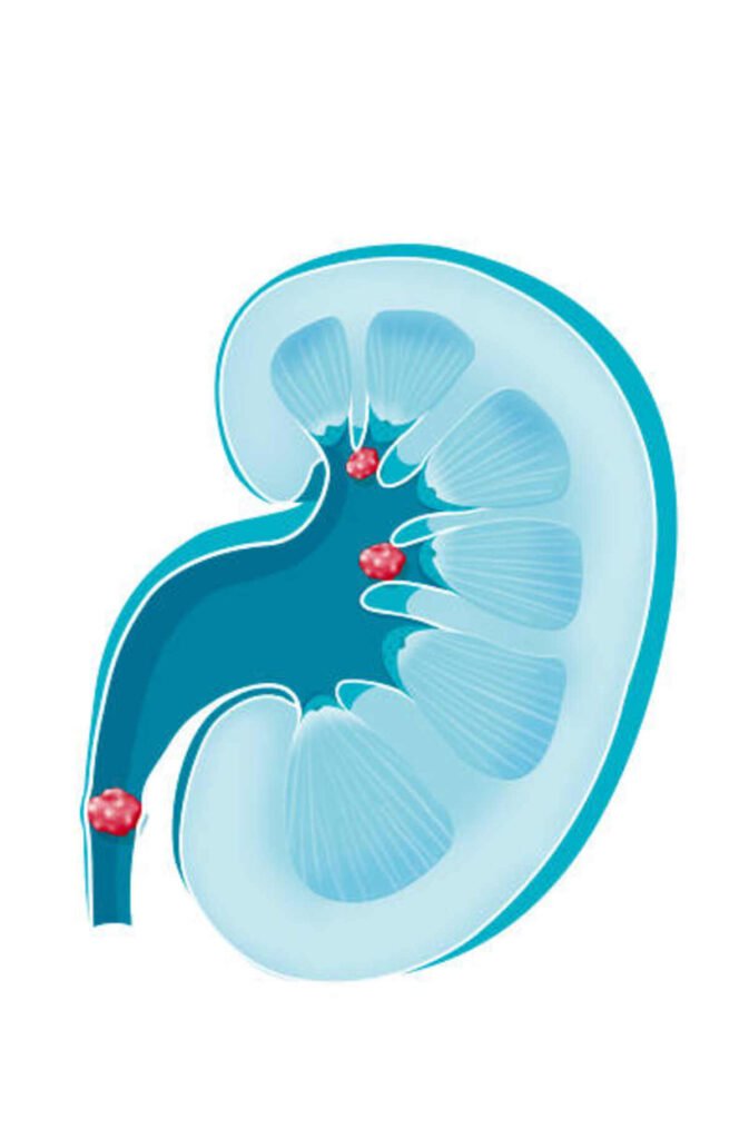 kidney stones