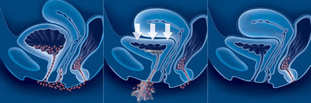 urinary tract infection