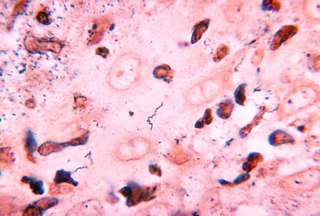 syphilis symptoms