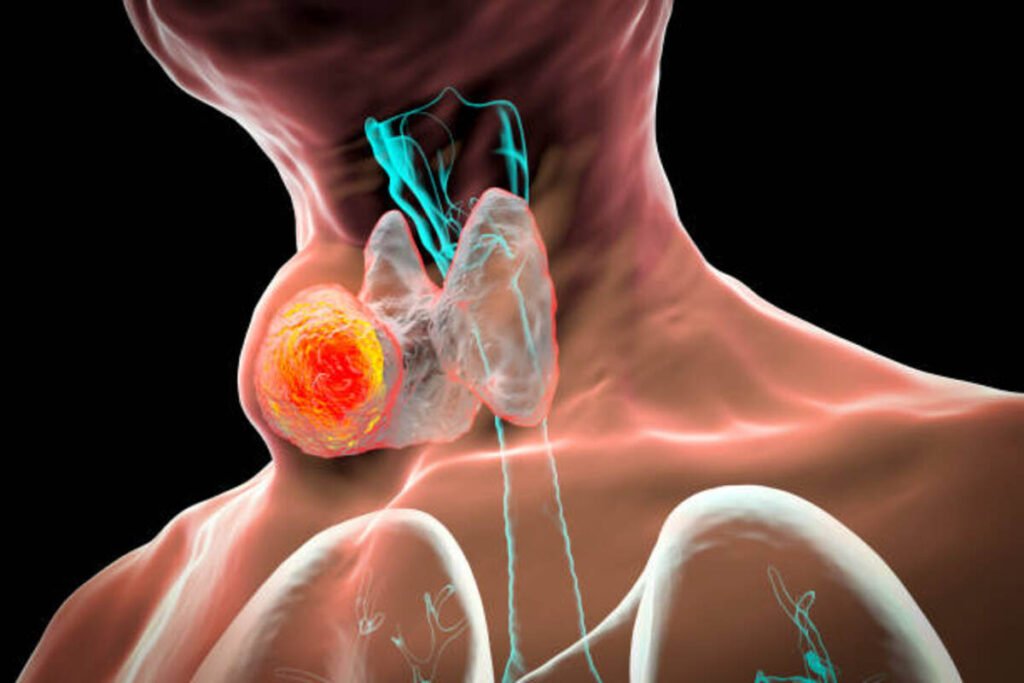 thyroid cancer
